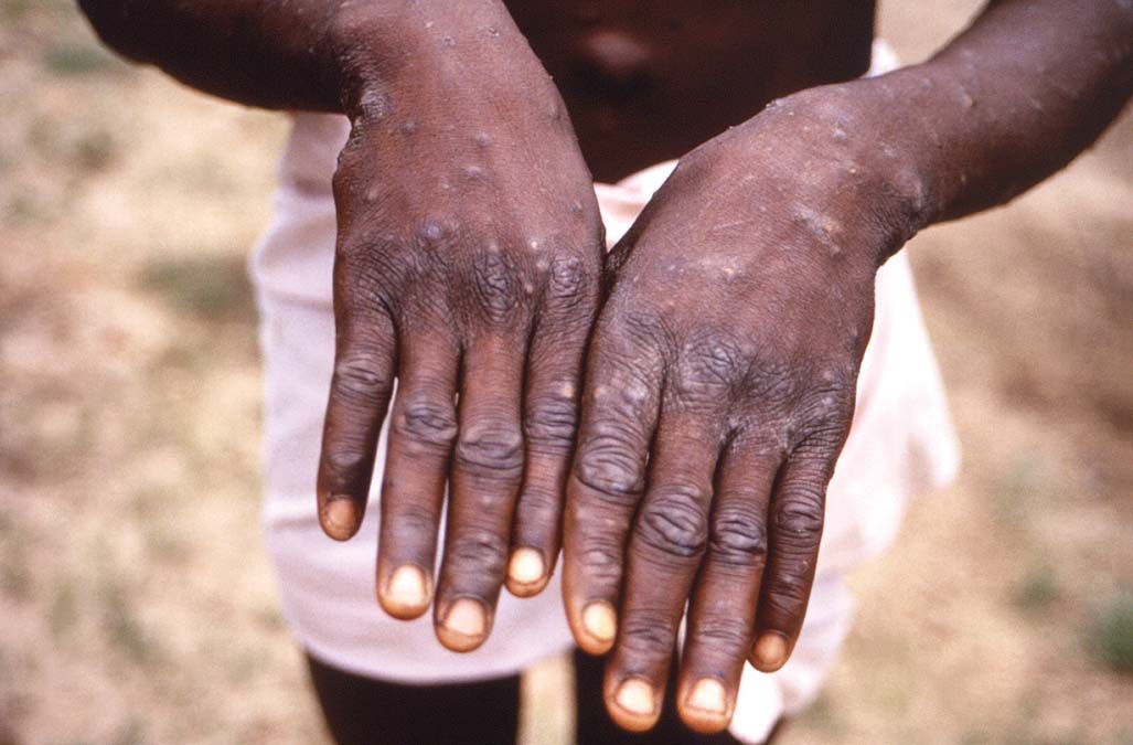 1997-ben készített kép egy majomhimlővel fertőzött beteg kézfejéről a Kongói Demokratikus Köztársaságban <br> Fotó: AP / CDC