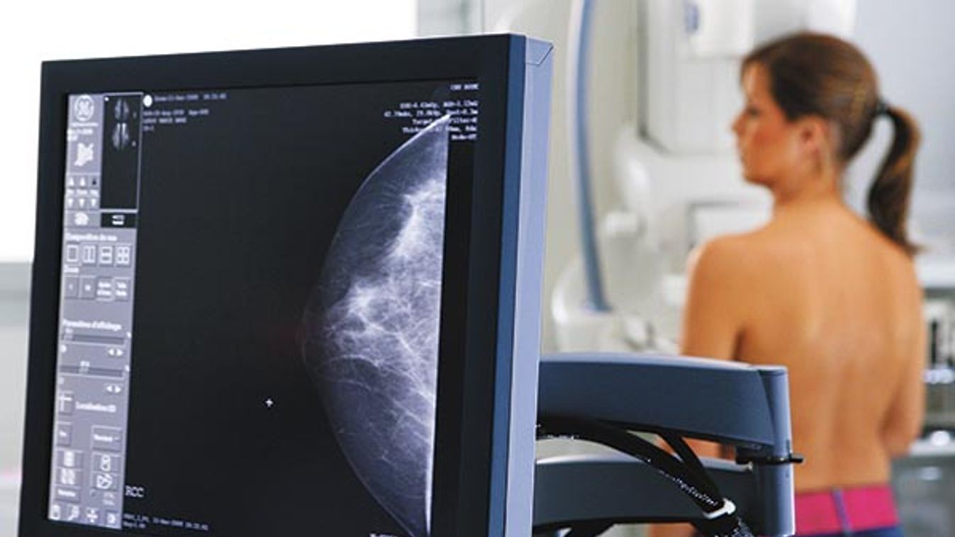 MAMMOGRAPHY RESULT