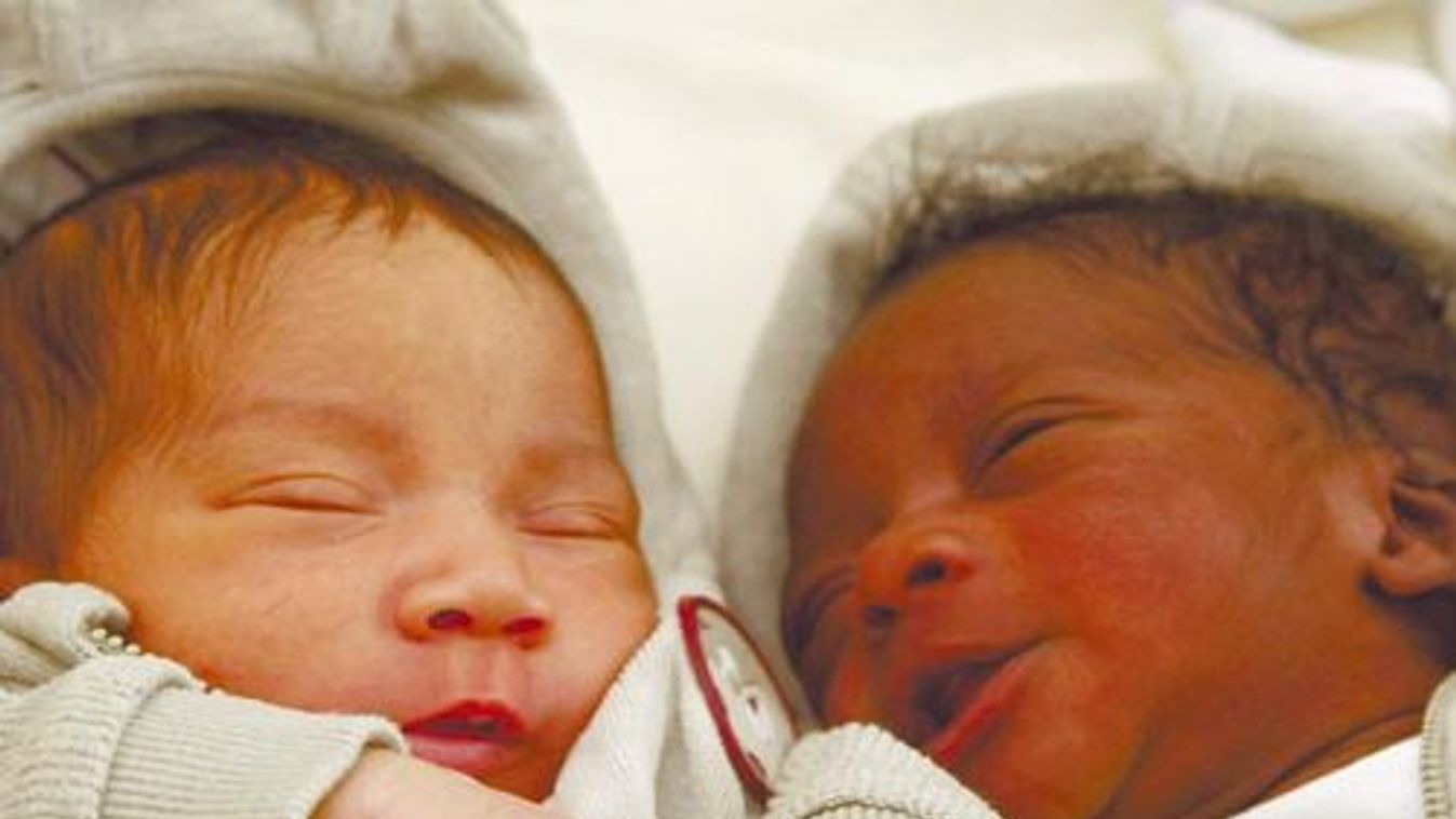 Rare different coloured  twin boys Ryan and Leo Gerth rest in a Berlin hospital