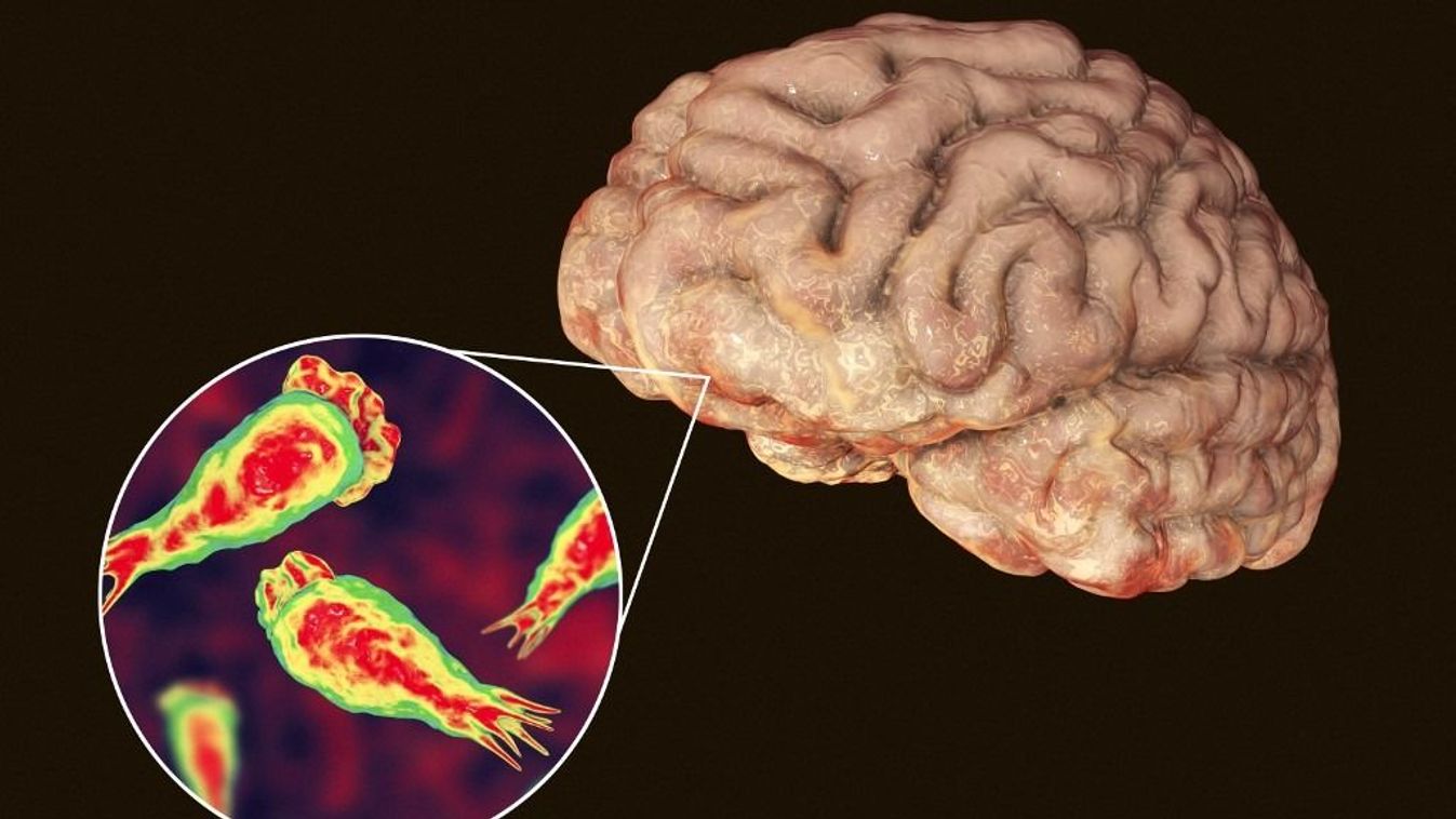 Brain-eating amoeba infection, illustration