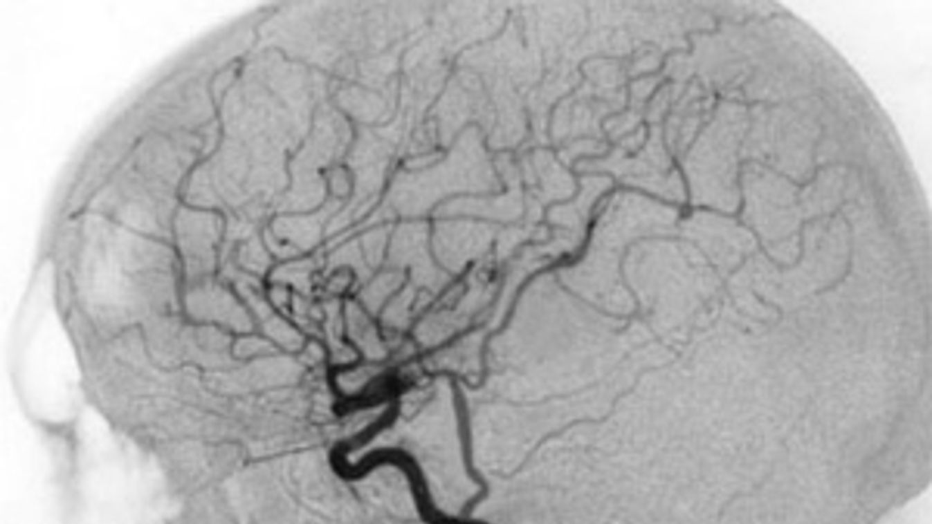 A stroke megelőzése