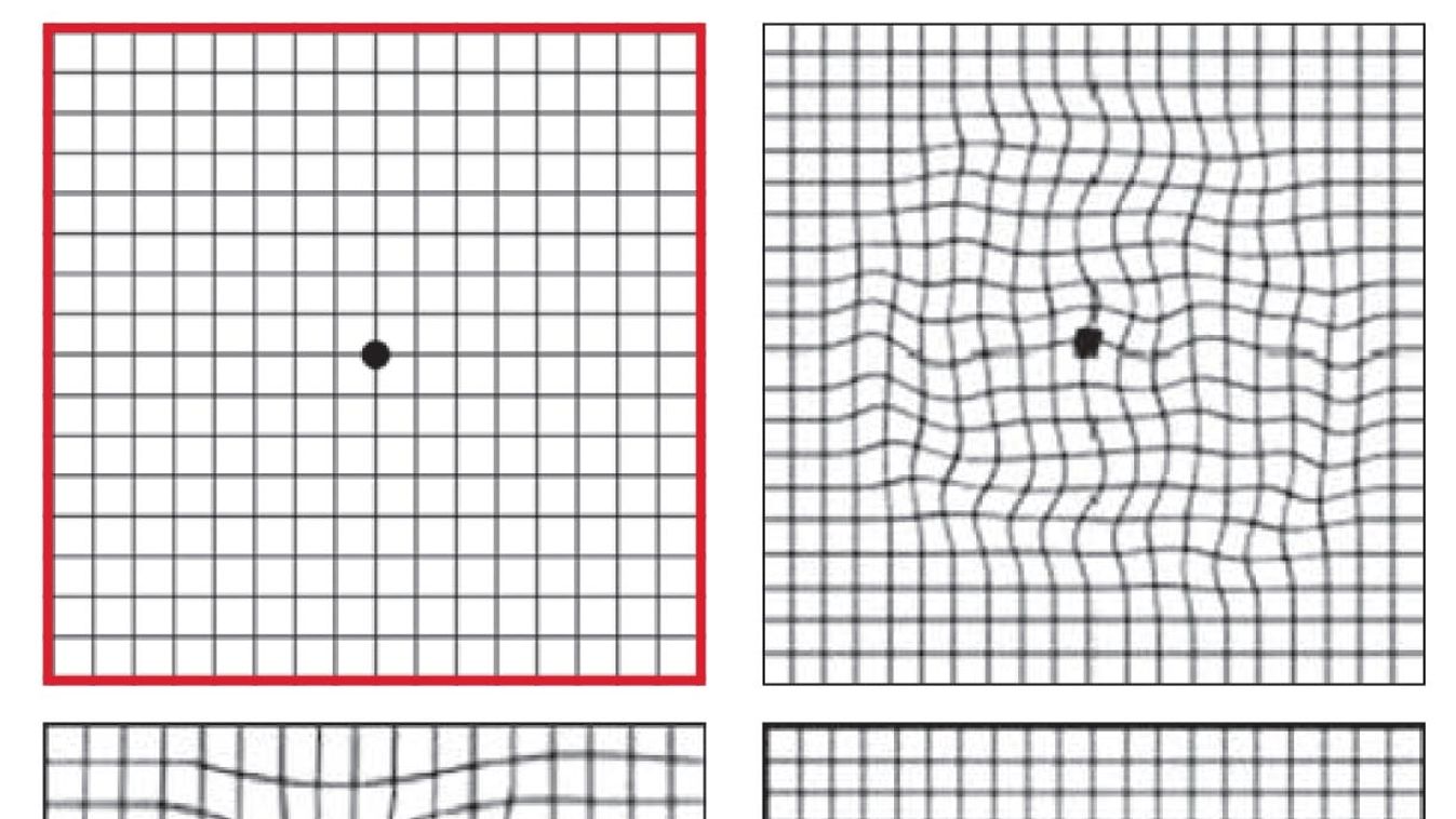 Tesztelje a látását! - Itt kipróbálhatja az Amsler-rácsot