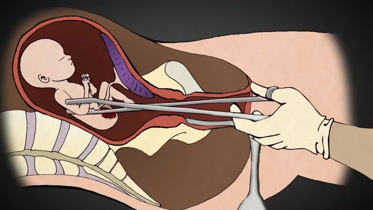 Gyomorforgató oktatóvideó: így tépik ki az anyából a még meg nem született csecsemőt, végtagról-végtagra (VIDEÓ)