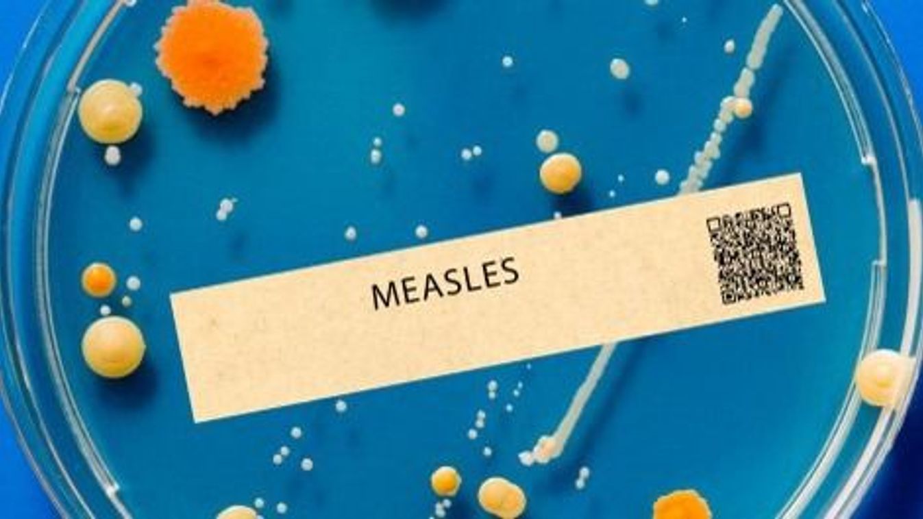 Measles viral infection