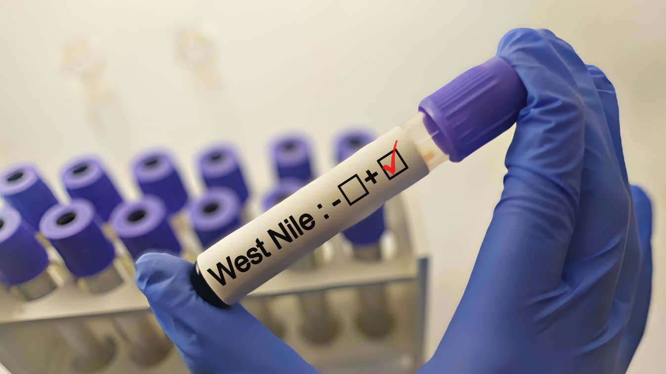 West,Nile,Positive,Blood,Sample.,Blood,Sample,For,West,Nile