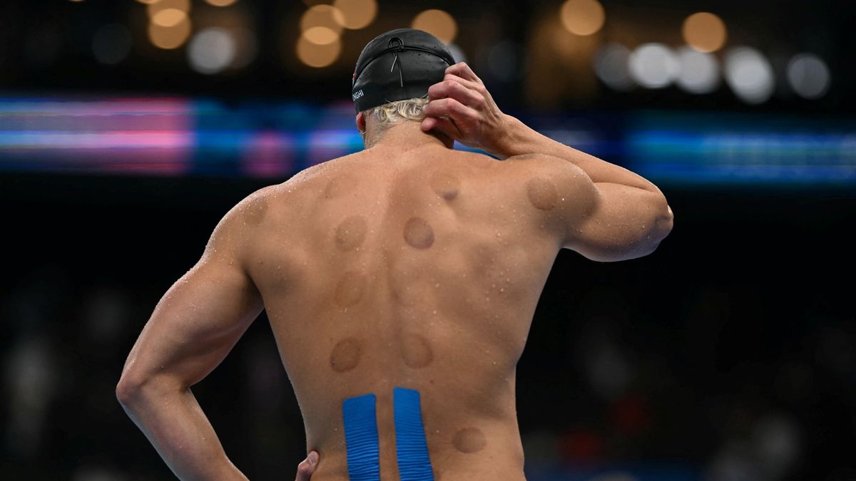 Szokatlan foltok a bőrön: mi az a köpölyözés, amit az olimpikonok is alkalmaznak?