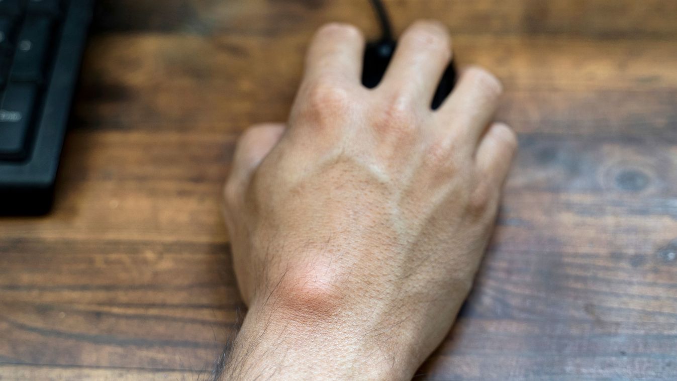 Ganglion,Cyst,On,Man's,Hand.,Hand,Holding,Computer,Mouse.