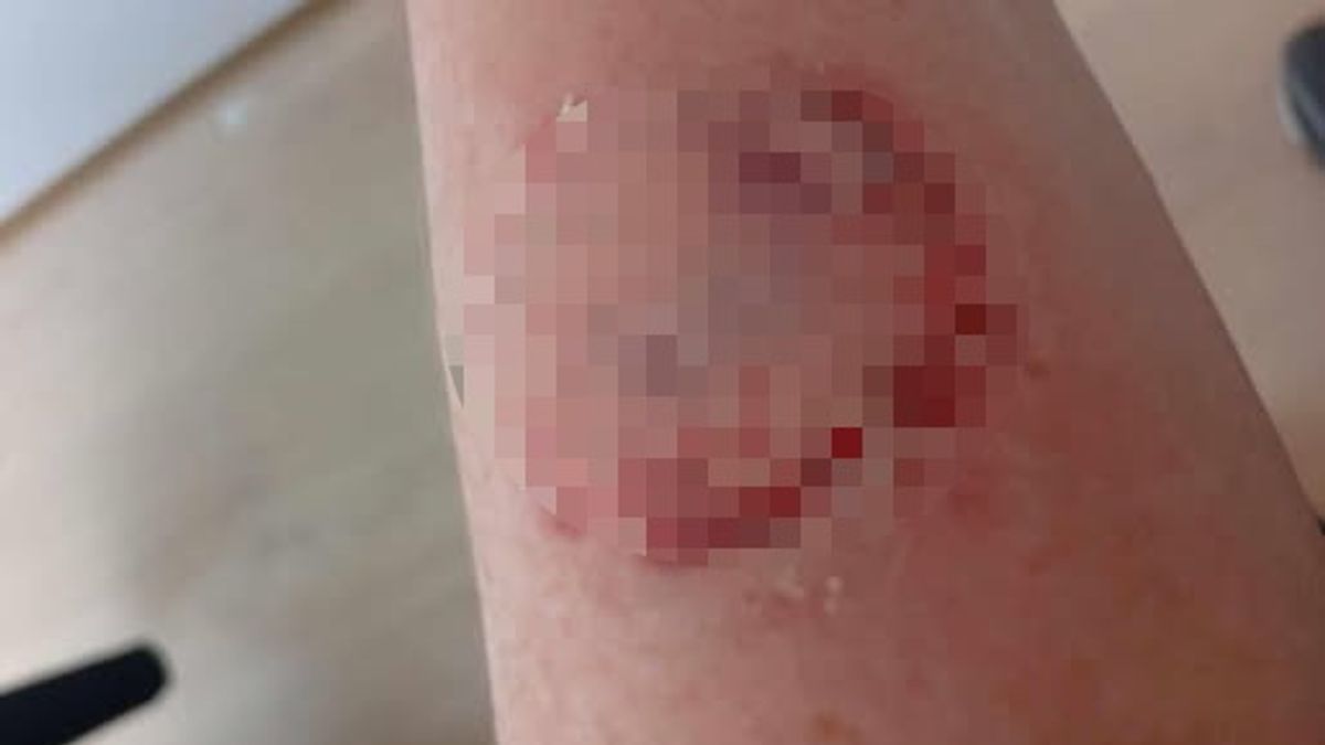 Megharapott egy magyar idegenrendészt a vietnámi nő, csúnya sérülést okozott (FOTÓ)