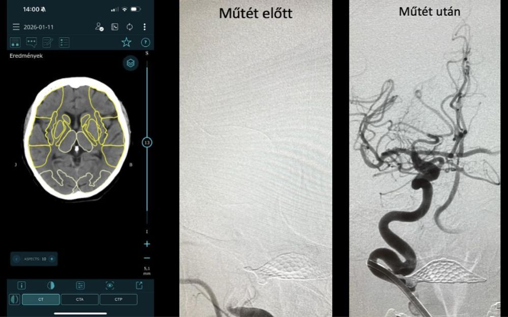 Stroke: évente 30 ezer érintett. A képen a cikkben szereplő nő agyáról készült CT látható a beavatkozás előtt és után. Kép forrása: OMSZ
